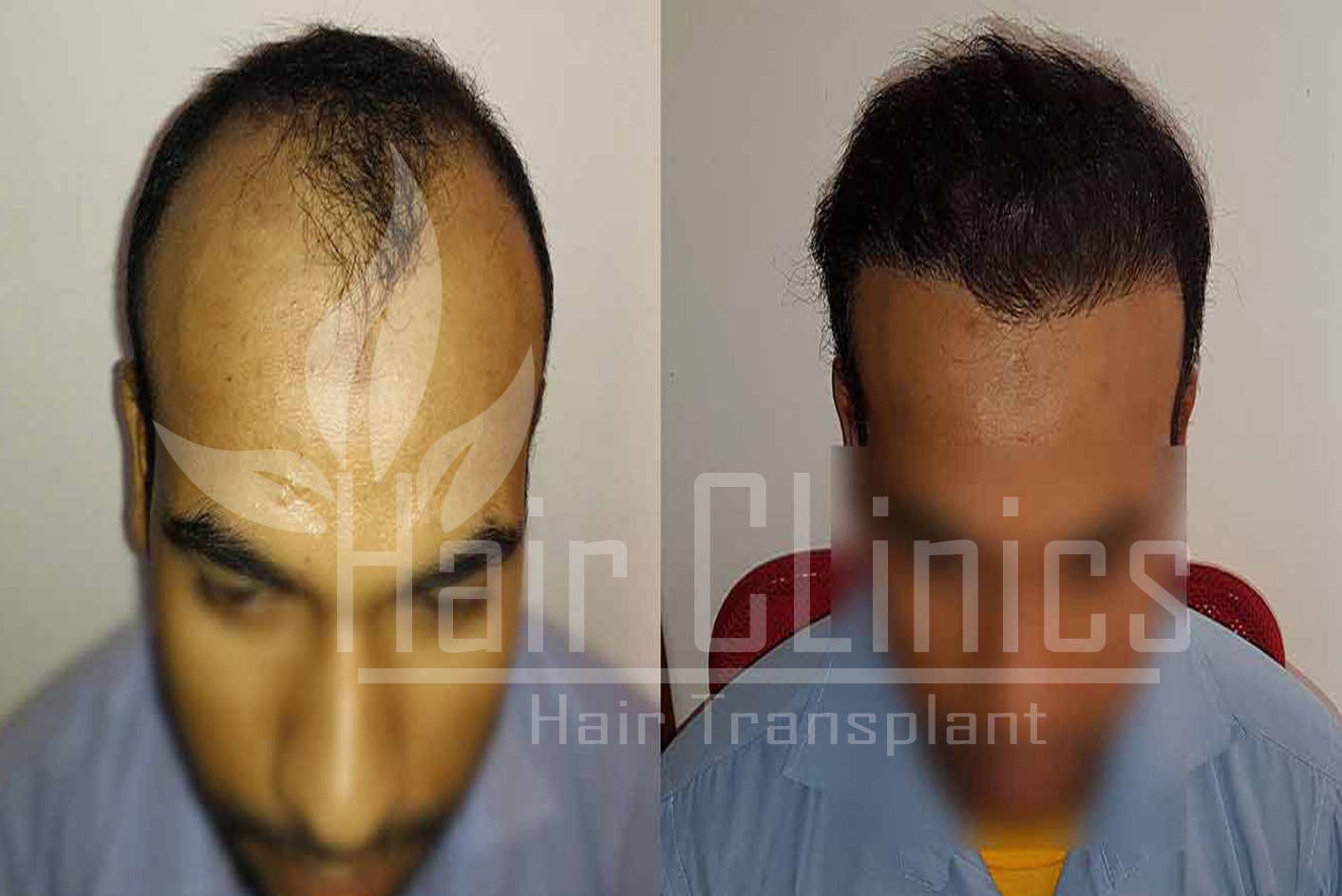 Hair Transplant results for 3000 grafts in Kollam
