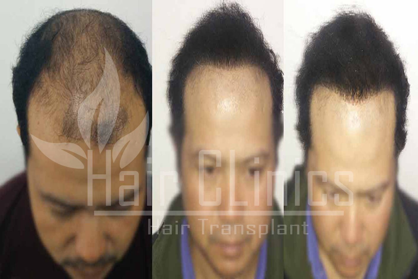 Thane | Advance FUE, FUT, PRP Therapy Hair Transplant Clinic in Thane | Hair  Transplant At Lowest Cost in Thane