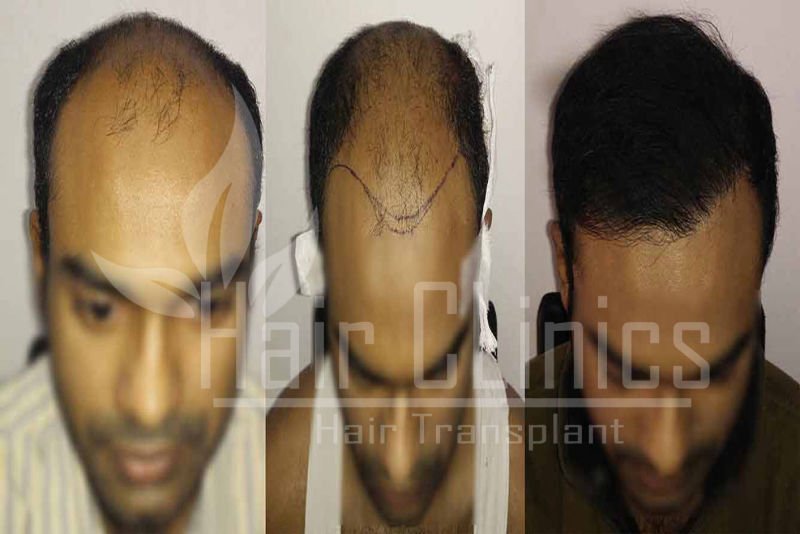 Hair Transplant results for 4500 grafts in Kanpur