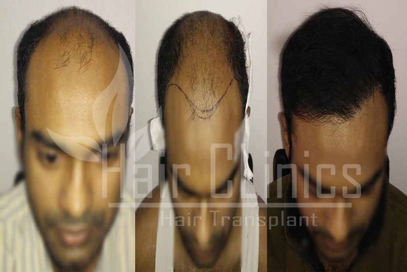 Hair Transplant results for 4500 grafts in Kollam