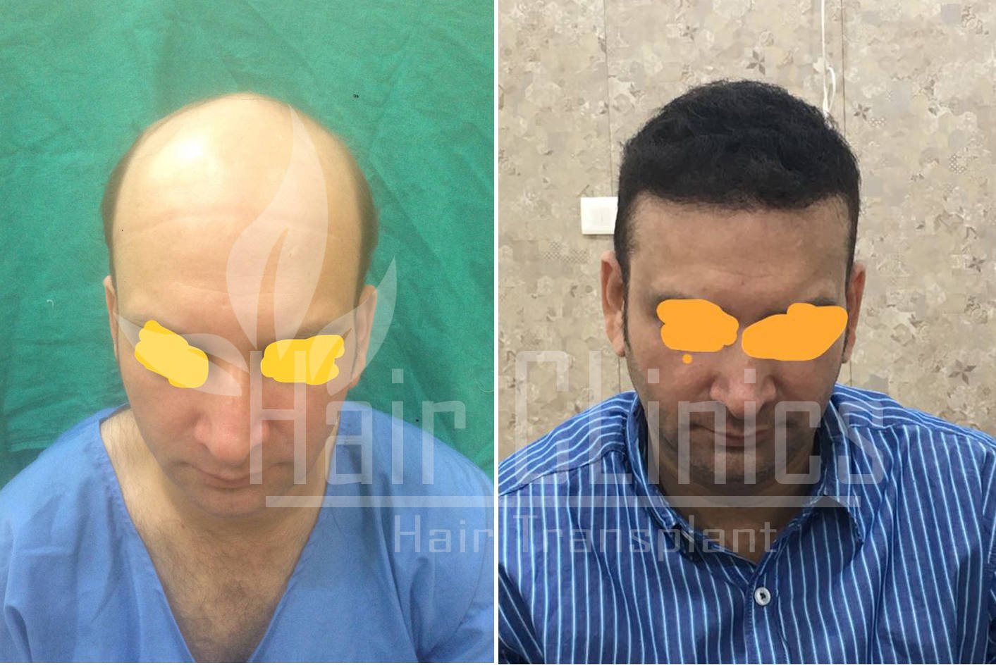 Hair Transplant results for 4500 grafts in Kanpur