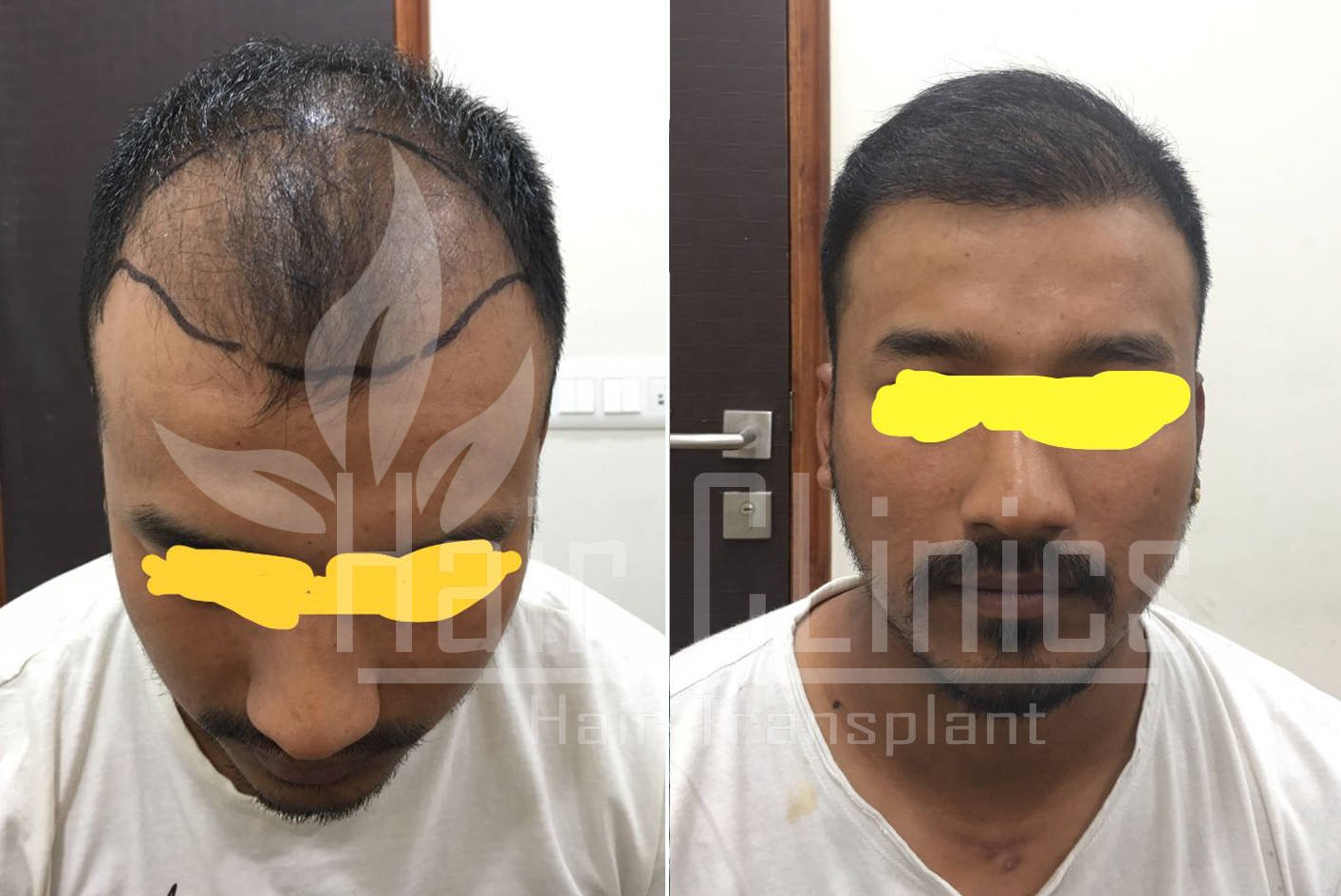 Best Hair Transplant In Thane  PVR Aesthetica