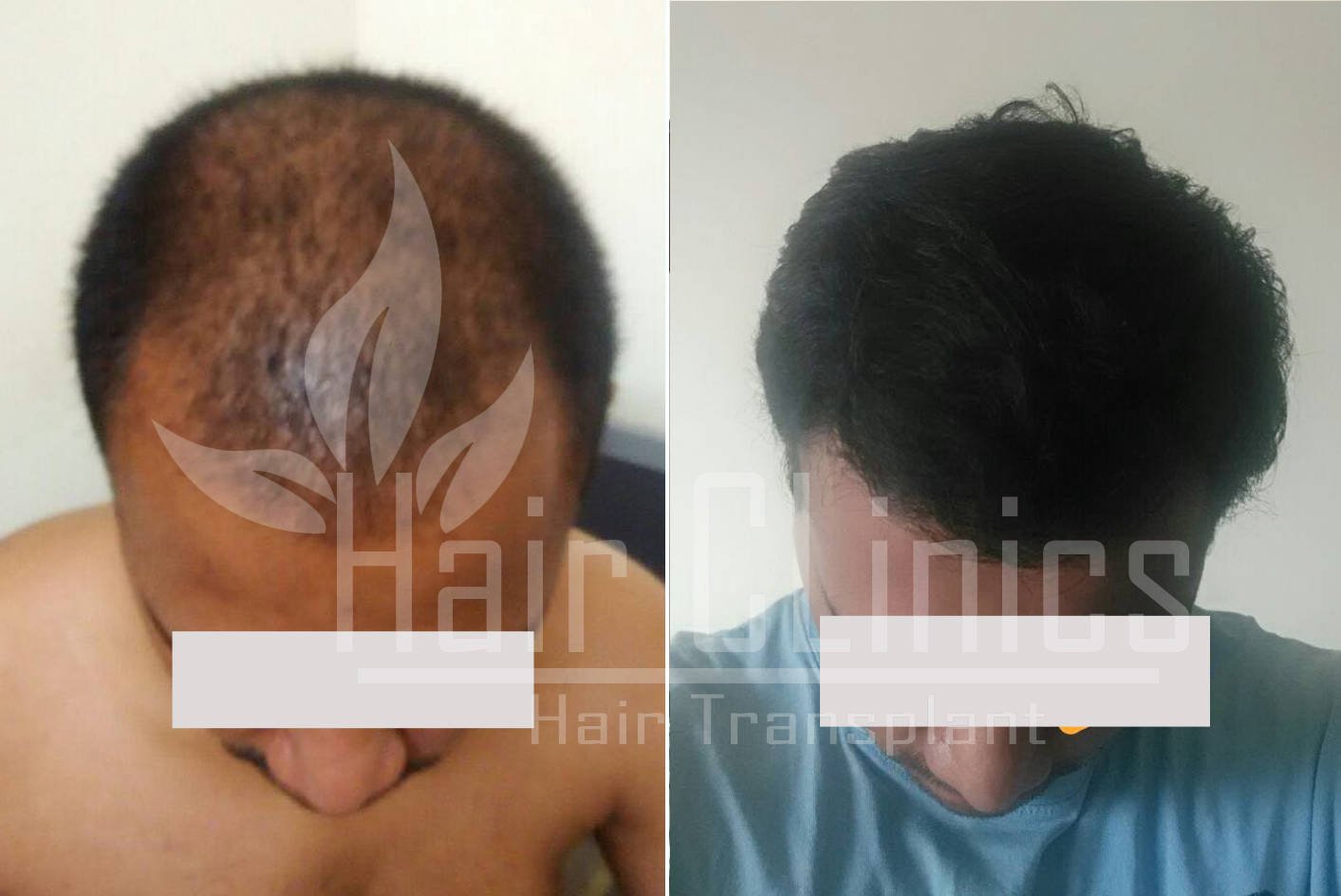 Hair Transplant results for 4000 grafts in Kollam