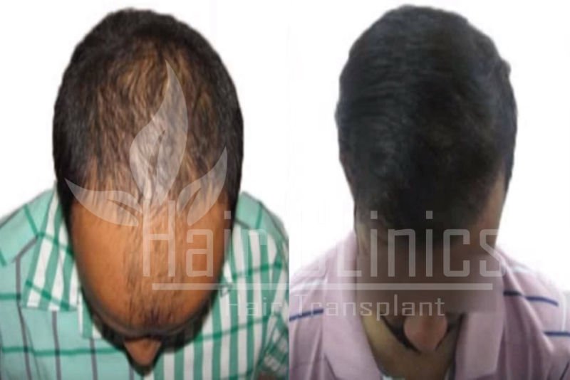 Hair Transplant results for 2800 grafts in Kanpur